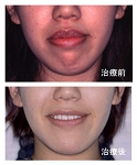 治療前後(正貌写真)