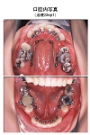 治療中の口腔内写真１