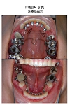 治療中の口腔内写真２