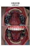 治療中の口腔内写真３