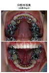 治療中の口腔内写真４