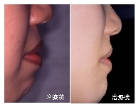 治療前後（側貌写真）