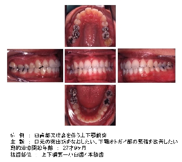 治療前の口腔内写真